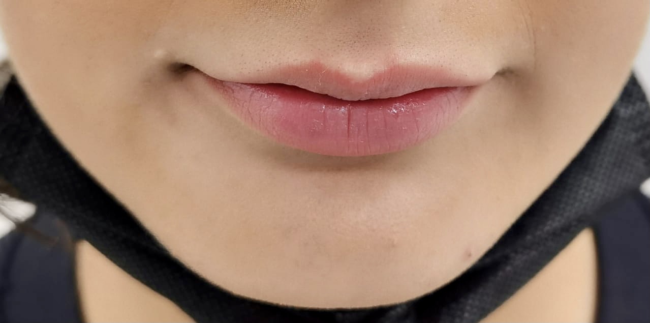 Before-Lip Filler