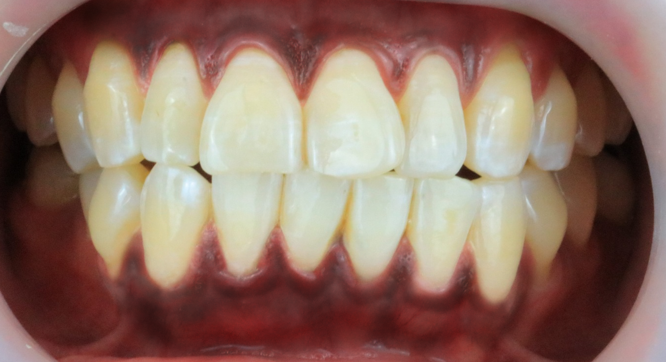 Before-Gum Bleaching