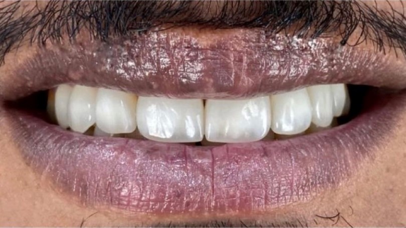 After-Hollywood Smile