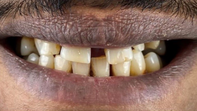 Before-Hollywood Smile